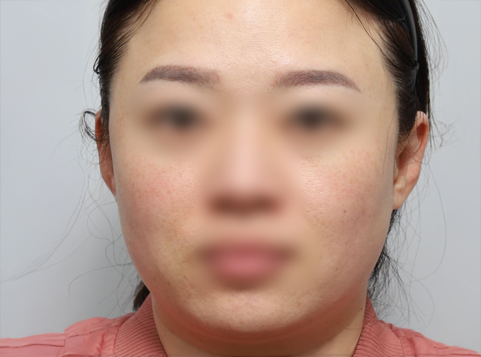 애프터사진
